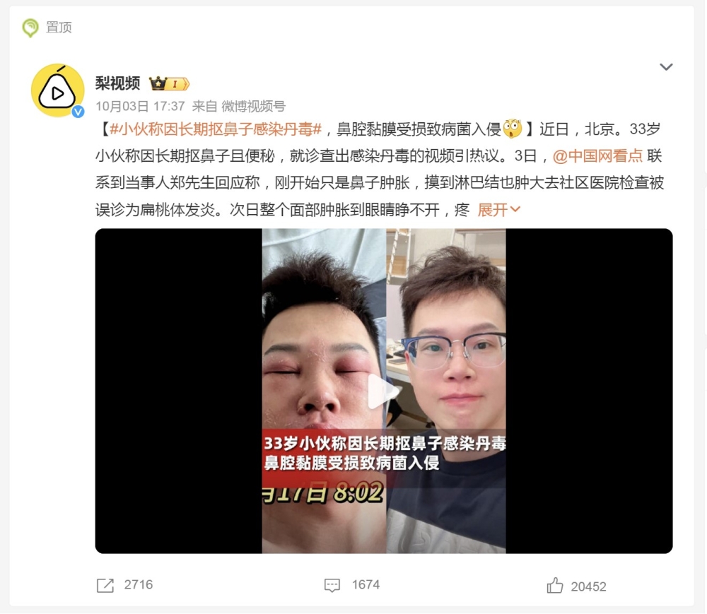 此事于周二（3日）在微博传开后，“#小伙称因长期抠鼻子感染丹毒”的标签也登上热搜榜第一位。-摘自网络-