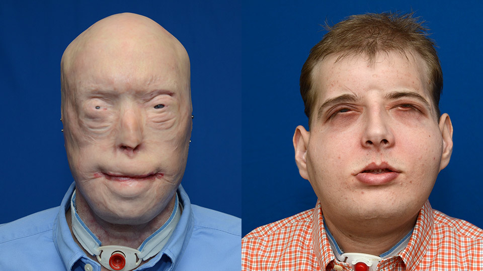 Patrick Hardison, 42, a father-of-five whose face was destroyed while he was fighting a fire back in 2001, has spoken of life since he had a full-face transplant.-picture via NYU Langone medical centren