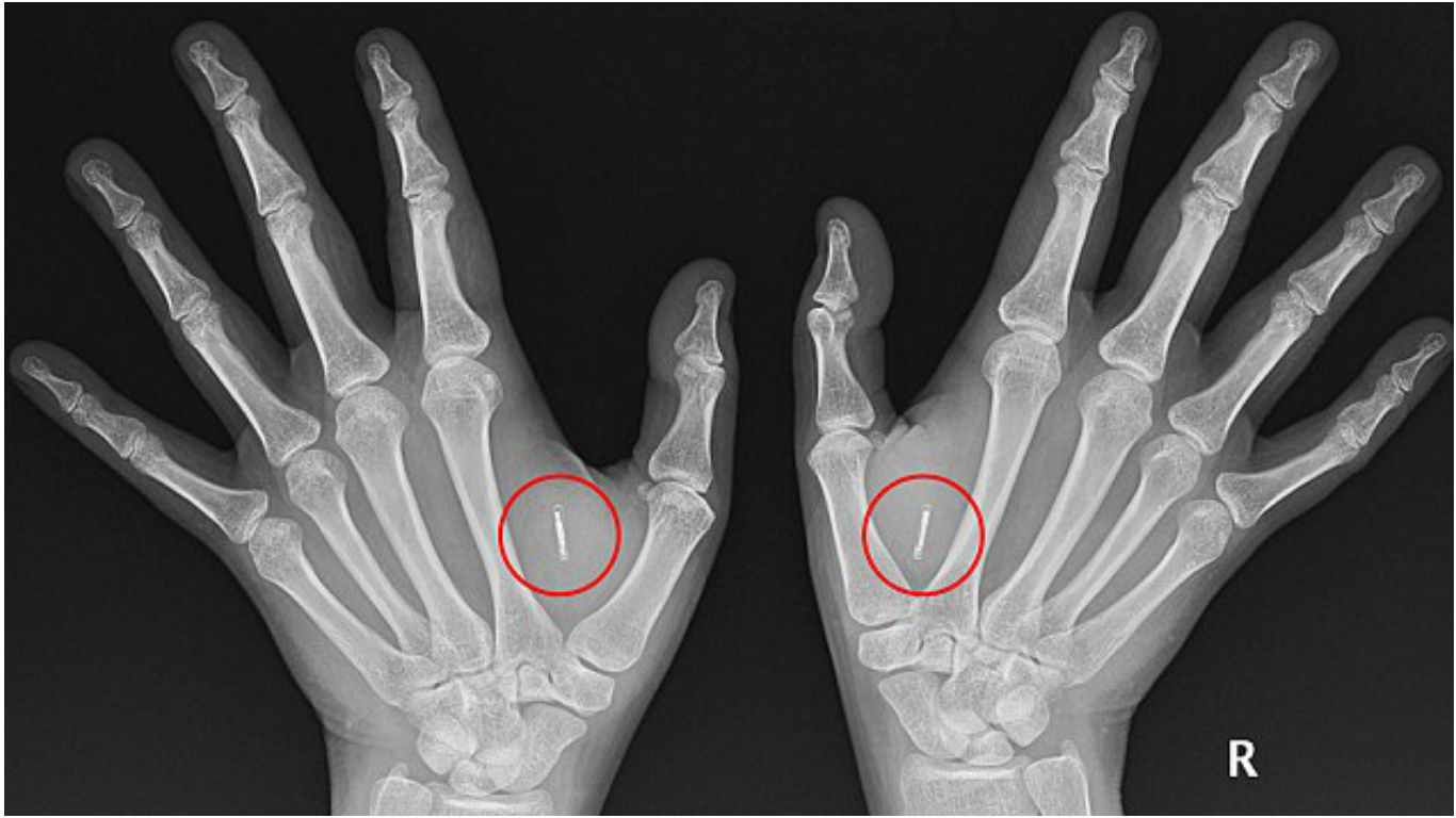 australia woman has microchips implanted in hands to unlock doors - picture via  dailymail