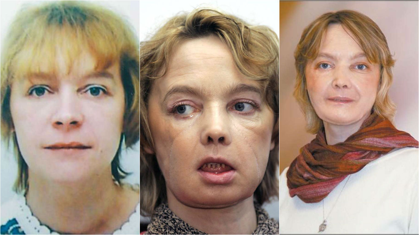first face transplant patience dies of cancer-pic via APn