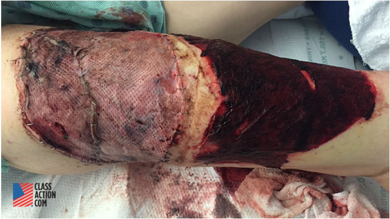 拉米雷斯腿部被判定为三度烧伤，并且执行了痛苦的植皮手术。-图取自ClassAction.com.-
