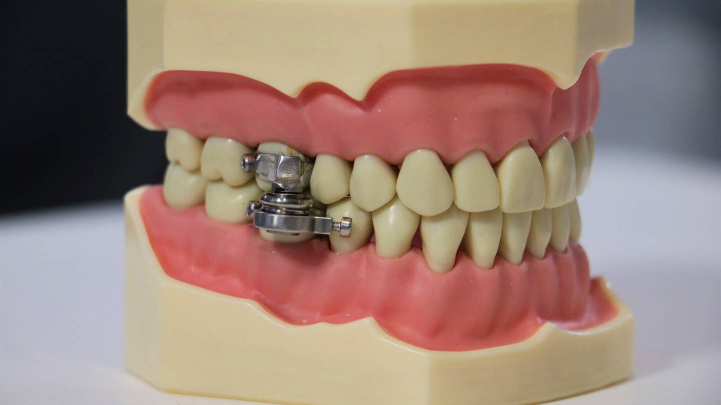 DentalSlim Diet Control 装置具有侵入性较小、危险性较低、且相对人性化。